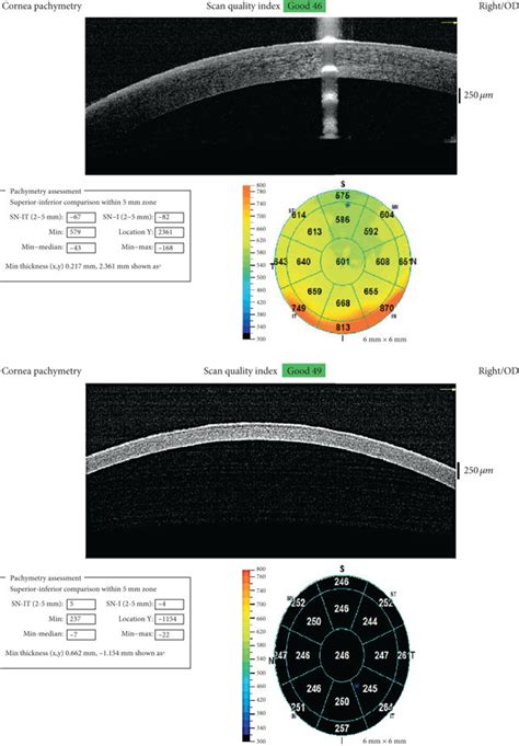 oct measurement for corneal thickness|anterior segment oct pachymeter.